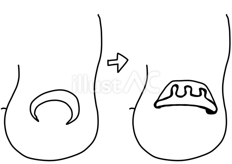 巻き爪の治療　線画 巻き爪,治療,足のイラスト素材