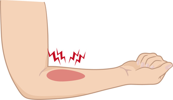 上腕の痛み 上腕の痛み 腕,上腕,前腕,肘,手,手首,指,関節,痛い,痛みのイラスト素材