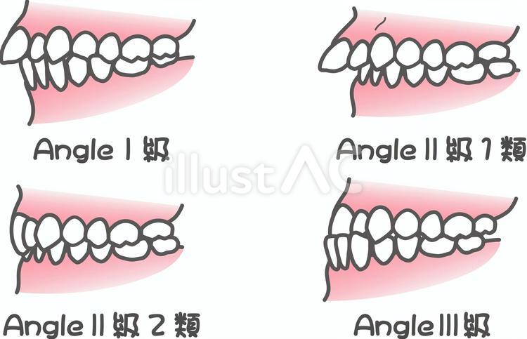 アングルの不正咬合分類 アングル,不正咬合,矯正のイラスト素材