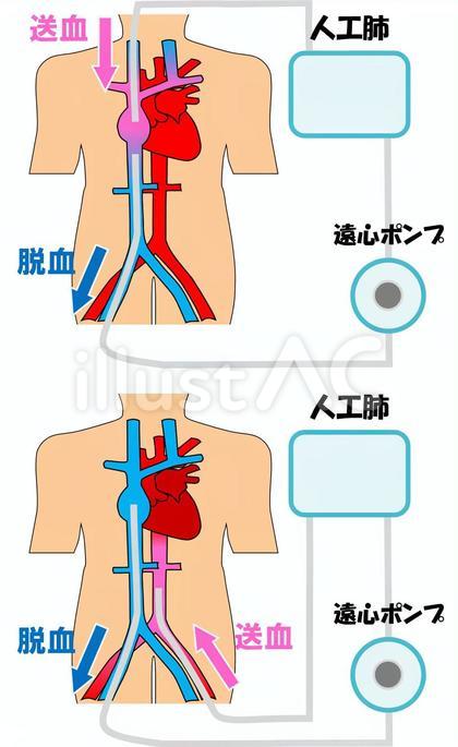 ECMO(経皮的人工心肺)