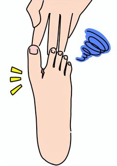 母趾と第二趾の間にひび割れ　カラー 母趾,指間,ひび割れ,トラブル,足,カラーのイラスト素材