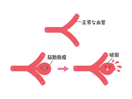 くも膜下出血2 くも膜下出血,血管,脳動脈瘤,医療,出血,破裂,病気,かわいい,イラスト,素材のイラスト素材