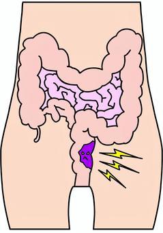 直腸付近の腫瘍　カラー 直腸,大腸,病気,腫瘍,ガン,カラーのイラスト素材