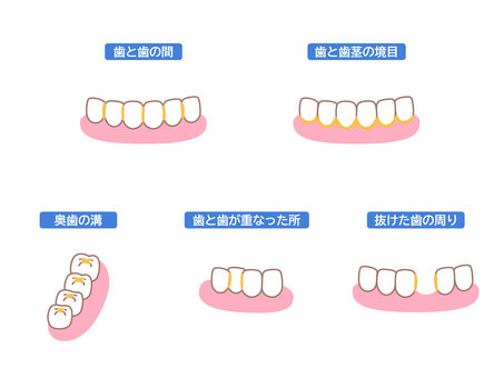 歯垢のたまりやすい場所のイラストセット 歯垢,プラーク,歯間,歯茎,歯科のイラスト素材