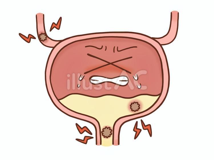 尿路結石の膀胱(カラー) 膀胱,尿路結石,尿のイラスト素材