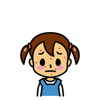 女の子　発疹 発疹,子供,湿疹,水疱瘡,病気,症状,皮膚疾患,アレルギー,麻疹,水疱のイラスト素材