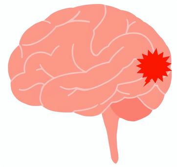 脳みそ・疾患・後頭葉 脳みそ,手描き,脳,大脳,血管障害,後頭葉,高次脳機能障害,断面,病気,障害のイラスト素材