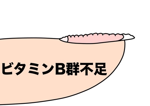 ビタミンB群不足により凹凸のある爪　 ビタミンb群不足,爪,凹凸,異常,カラーのイラスト素材