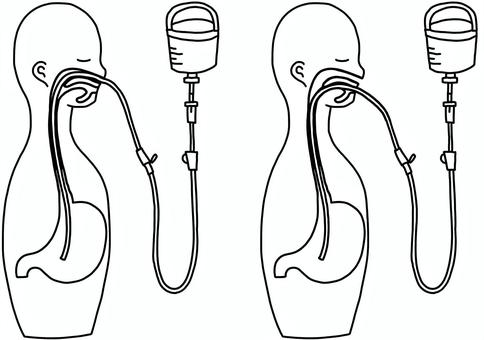 経管栄養の挿入位置比較 線画 経管栄養の挿入位置比較 線画 経管栄養,注入,経鼻,経口,比較,線画のイラスト素材