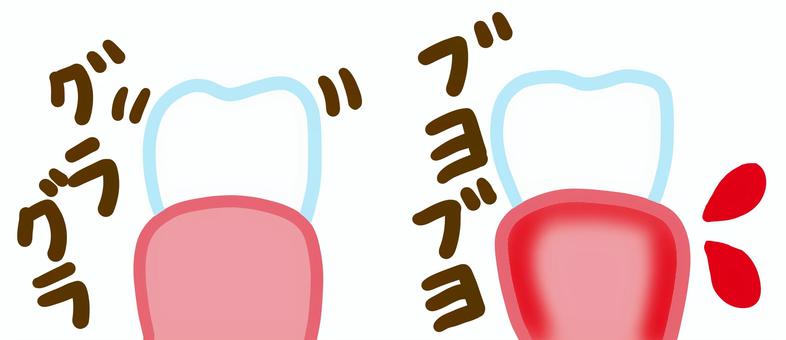 歯がグラグラ、歯茎がぶよぶよ 歯がグラグラ、歯茎がぶよぶよ 歯,歯茎,ぶよぶよ,グラグラ,歯肉炎,歯周病,出血,血,出る,揺れるのイラスト素材