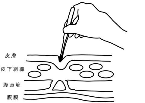 へそごまをピンセットで取る 線画 へそごまをピンセットで取る 線画 へそごま,皮膚,ピンセット,断面,線画のイラスト素材