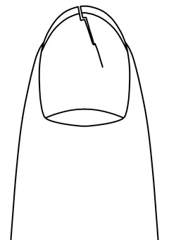 縦にひび割れた爪　線画