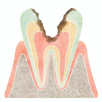 Cross section of cavities (C3), dente, seção cruzada, cárie, JPG and PNG