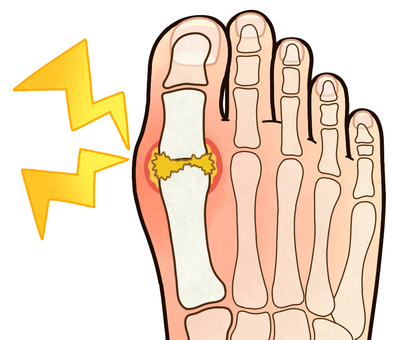 痛風発作の関節の状態 痛風,発作,図解,尿酸,尿酸値,尿酸結晶,生活習慣病,激痛,痛み,炎症のイラスト素材