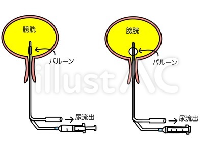留置カテーテルのバルーン使用 文字有色付