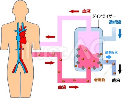 血液透析