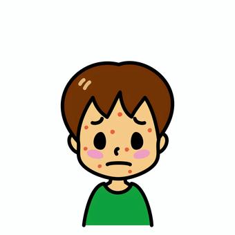 男の子　発疹 発疹,子供,湿疹,顔,水疱瘡,病気,症状,皮膚疾患,アレルギー,麻疹のイラスト素材