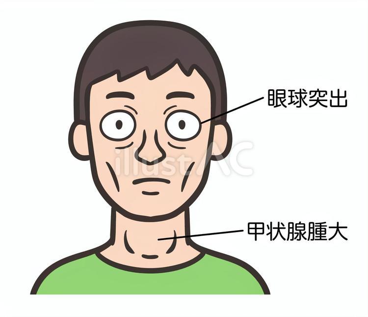 眼球突出と首の腫れがある男性の顔 眼球突出,バセドウ病,甲状腺機能亢進症のイラスト素材