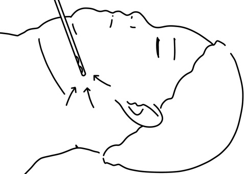 顎下の脂肪吸引をする　線画 顎下,脂肪吸引,贅肉,美容整形,線画のイラスト素材