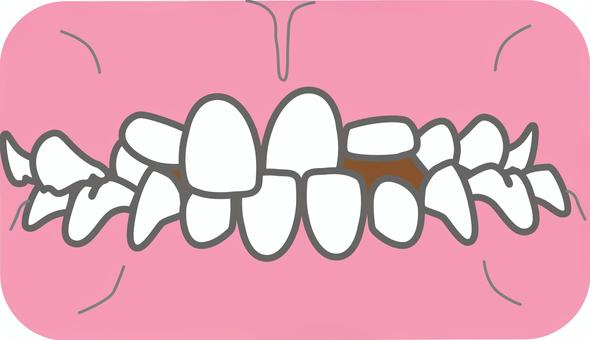 混合歯列期の交差咬合 歯科,歯並び,交差咬合,混合歯列,前歯,かみ合わせ,矯正,ずれのイラスト素材