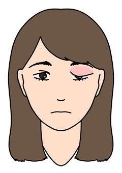 ものもらいのある女性　カラー ものもらい,女性,腫脹,異常,目,カラーのイラスト素材