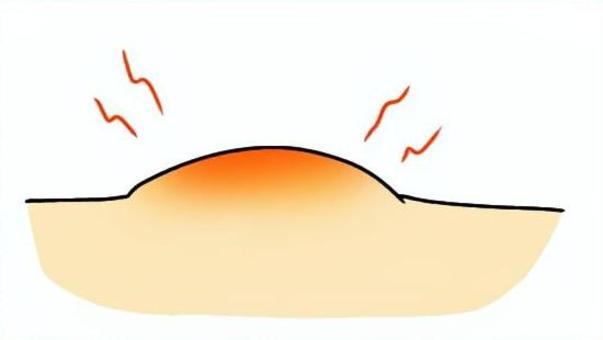 虫刺され 虫刺され,痒い,腫れ,肌,手書きのイラスト素材
