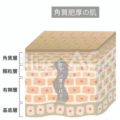 角質肥厚 肌の断面図 立体