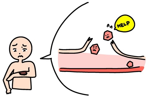 血小板が少なく出血　カラー 血小板,血管,異常,出血,カラーのイラスト素材