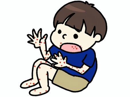 手足口病　男の子 手足口病,感染症,夏風邪,ウイルス,男の子,病気,疾患,流行,医療,保健のイラスト素材