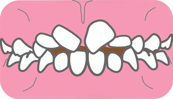 生え変わり_翼状捻転 歯科,生え変わり,翼状捻転,永久歯,乳歯,萌出,矯正,混合歯列,歯並び,叢生のイラスト素材