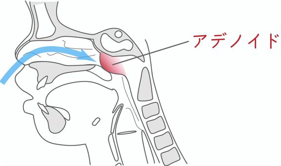 アデノイド 口呼吸,アデノイド,頭部断面図,鼻呼吸,お口ぽかん,子どものイラスト素材