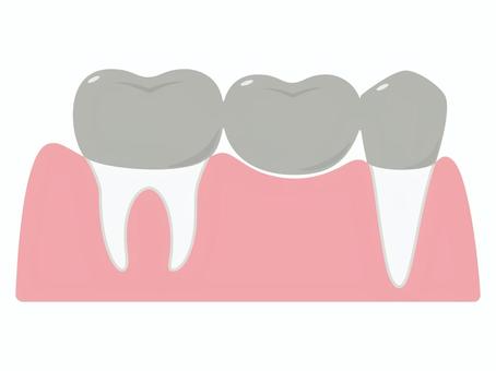 歯科　差し歯（ブリッジ）と歯根 ブリッジ,差し歯,冠,被せ物,歯,金属,単体,メタル,奥歯,臼歯のイラスト素材
