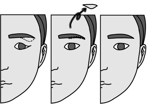 眉下切開で皮膚切除 過程白黒 眉下切開で皮膚切除 過程白黒 眉下切開,過程,美容整形,外科,白黒,美容医療のイラスト素材