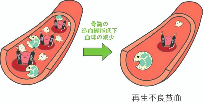 再生不良貧血 再生不良貧血,貧血,赤血球,白血球,血小板,血管,骨髄,造血機能低下のイラスト素材