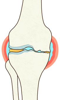 変形性膝関節症（正面） 膝,右膝,関節,軟骨,大腿骨,脛骨,腓骨,関節液,関節包,滑膜のイラスト素材