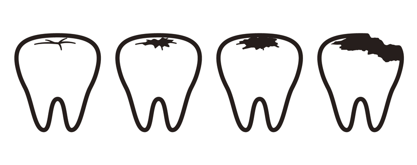 Illustration, diente, la caries dental, chequeo dental, 