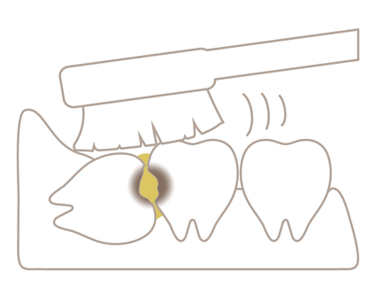 Wisdom tooth with cavities (poor cleaning) Wisdom tooth with cavities (poor cleaning)