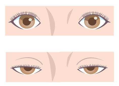 眼瞼下垂 眼瞼下垂 眼瞼,下垂,症状,図解,人体,人物,生活,カット,イラストのイラスト素材