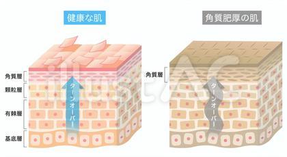 角質肥厚 健康な肌 断面図 立体