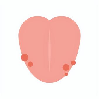 舌のフチにできた口内炎 舌のフチにできた口内炎 口内炎,舌,ベロ,口腔,口内,歯科,口腔外科,口臭,オーラルケア,症状のイラスト素材