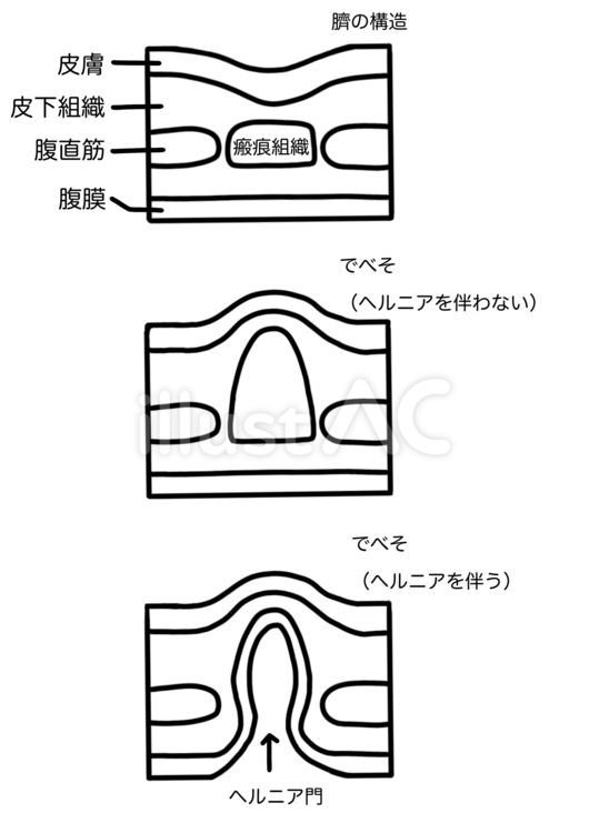 でべその内部　種類　文字あり線画 でべそ,臍,瘢痕組織のイラスト素材