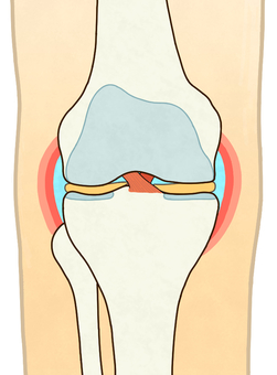 前十字靭帯（輪郭あり） 前十字靭帯,後十字靭帯,膝,右膝,関節,軟骨,半月板,大腿骨,脛骨,腓骨のイラスト素材