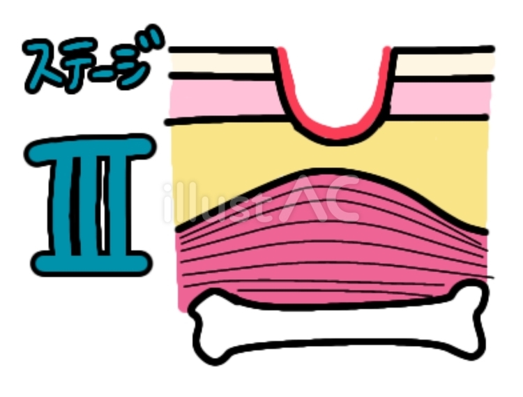 褥瘡ステージⅢ 褥瘡,design-r,表皮剥離のイラスト素材