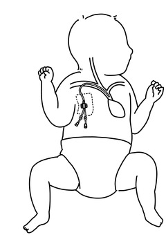 乳児に中心静脈カテーテル 線画 乳児に中心静脈カテーテル 線画 乳児,中心静脈,カテーテル,赤ちゃん,小児科,血管,線画のイラスト素材