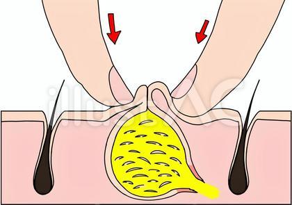 圧迫により粉瘤が中で破裂 カラー