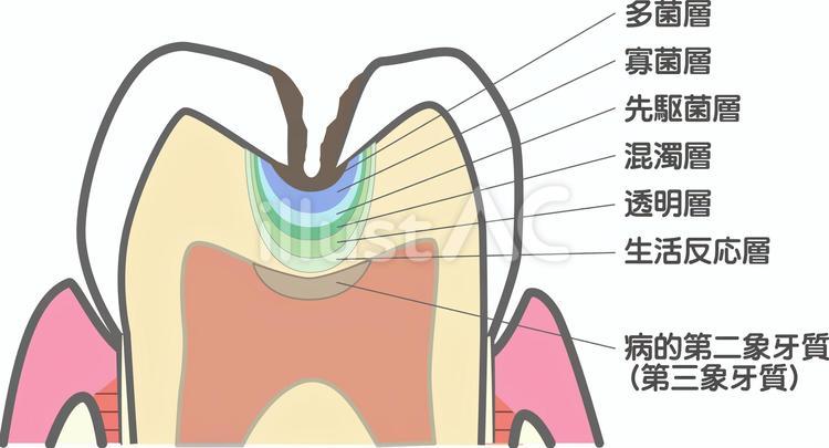 象牙質う蝕 むし歯,象牙質,う蝕のイラスト素材
