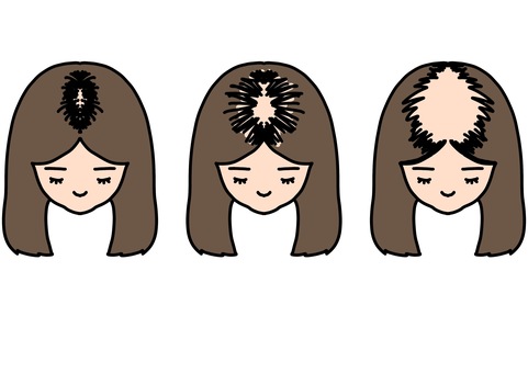 生え際の脱毛症拡大　カラー 生え際,頭皮,頭髪,女性,病気,脱毛症,カラーのイラスト素材