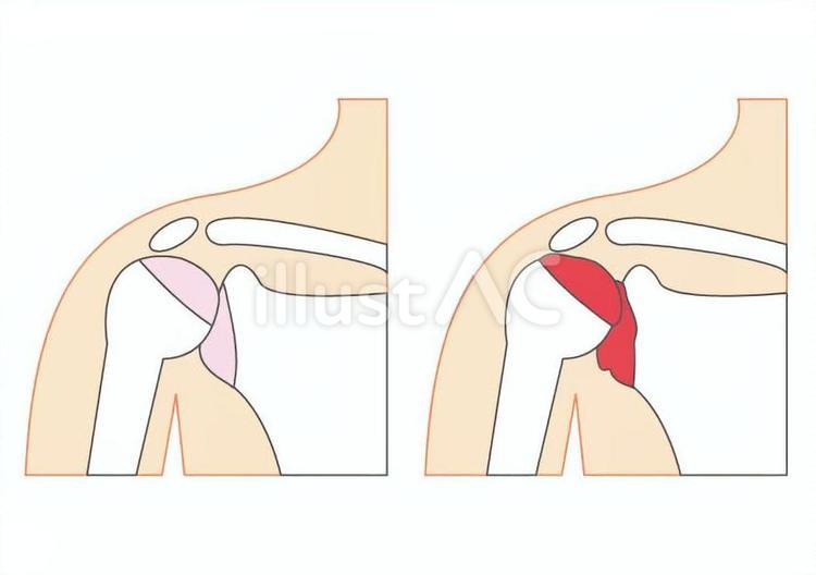 変形性肩関節症 変形性肩関節症,関節,リウマチのイラスト素材