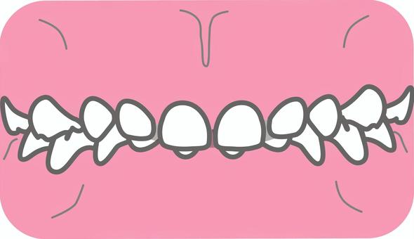 乳歯の過蓋咬合 歯,乳歯,乳歯列,過蓋咬合,矯正,歯科,子ども,歯並びのイラスト素材