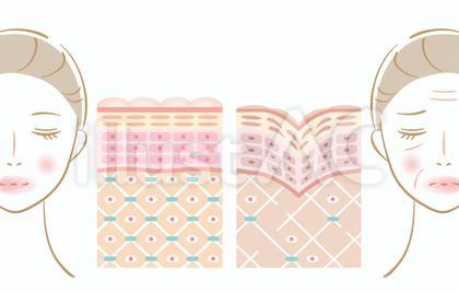 しわ 断面図と女性 ビフォアアフター